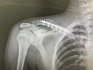 El novillero Jaime Padilla pasa por el quirófano